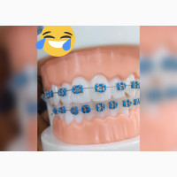 Teeth Braces
