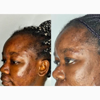 Advanced Skin Peel