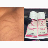Hoyin Skinbeauty Stretch Mark Butter