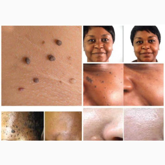 Skin Tag Removal Therapy
