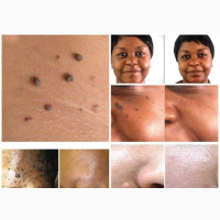 Skin Tag Removal Therapy