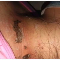 Warts, Skintag, and Genital Warts Removal