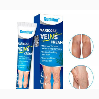 Varicose Vein Removal Cream/ Spider Vein Removal