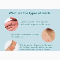 Get Rid of Genital Warts Now! Laser Therapy Available