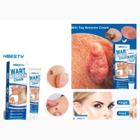 Skin Tag/ Genital Wart Foot Corn Removal Cream
