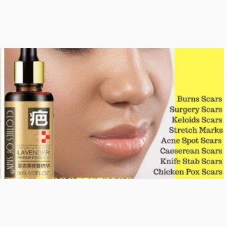 Lavender Stretch Mark Oil