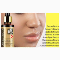 Lavender Stretch Mark Oil