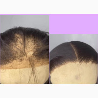 Frontal Fix and Refill