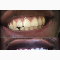 Teeth Whitening