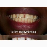 Teeth Whitening Kit