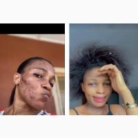 Acne Repair Face Soap
