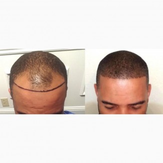 Hair Loss Treatment Cream - Regrow Hair Faster
