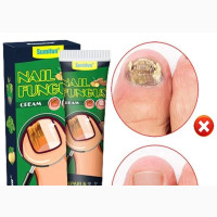 Nail Fungus Treatment Cream - Say Goodbye to Nail Fungus