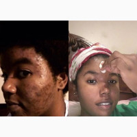 Acne Facial Treatment