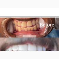 Laser Teeth Whitening