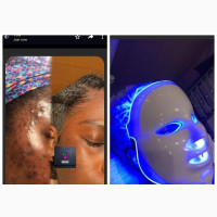 Acne and Pimples Facial Treatment - Get Rid of Skin Imperfections