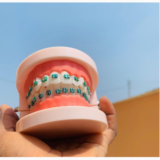 Fashion Braces - Enhance Your Smile