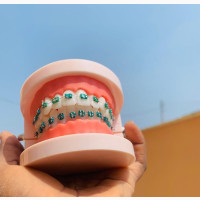 Fashion Braces - Enhance Your Smile
