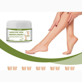 Varicose Veins Cream Removal Treatments