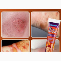 Burn Care Cream