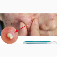 Powerful Acne and Pimples Treatment