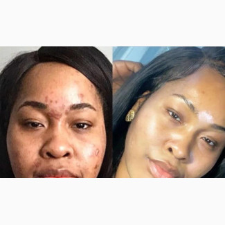 Pimples, Acnes, Blackheads And Whiteheads