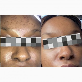 Facial Therapy