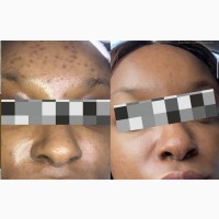 Facial Therapy