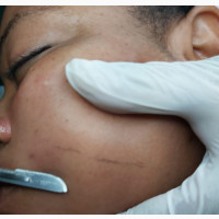 Dermaplanning Facial