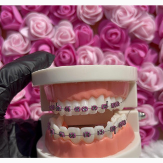 Pink Fashion Braces