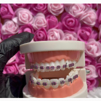 Pink Fashion Braces