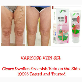 Varicose Vein Eraser Gel