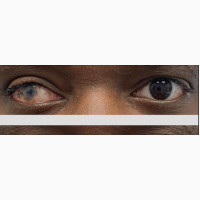Opticom Masking Contact Lenses - Disguise Scarring, Boost Confidence