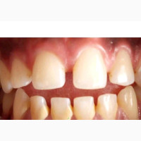 Scaling and Polishing