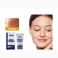 Effective Skin Wart, Skin Tags and Moles Removal